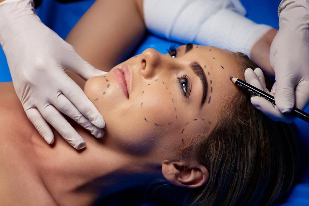 Plasztikai beavatkozást készítenek elő egy fiatalkorú nő arcán, az orvos fehér kesztyűben rajzolja fel a vonalakat a barna hajú páciens arcára